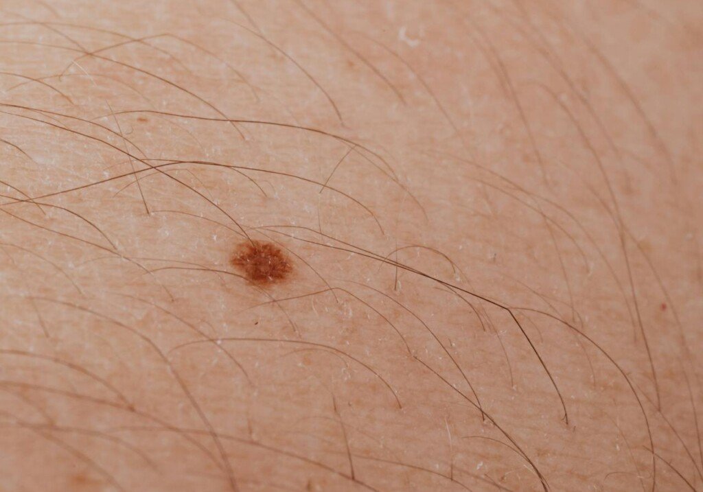 mole on skin